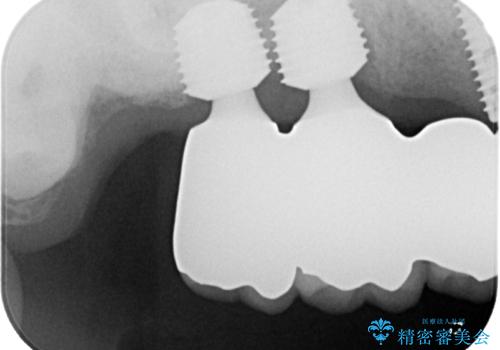 ぐらぐらする奥歯 短期間インプラント治療の治療後