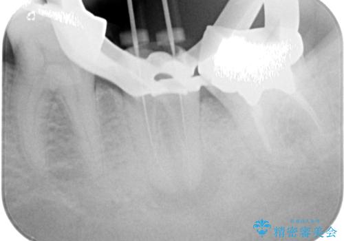 痛すぎて食事がとれない 奥歯の根管治療の治療中