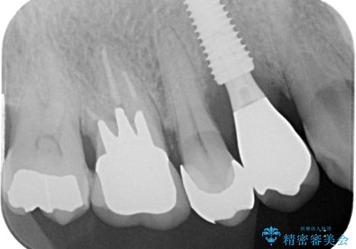 抜歯は避けたい? 1DAYインプラントに魅せられて抜歯即時埋入インプラントによる補綴治療の治療後