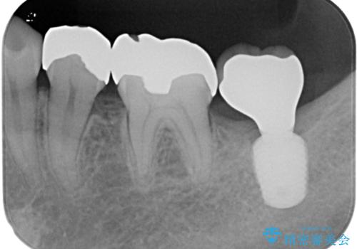 奥歯に歯を入れたい 即時荷重インプラントによる短期間インプラント治療の治療後