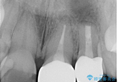 変色してきた歯とプラスチックのクラウン オールセラミッククラウン治療の治療後