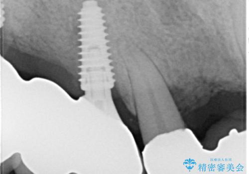 ぐらぐらする奥歯 短期間インプラント治療の治療後