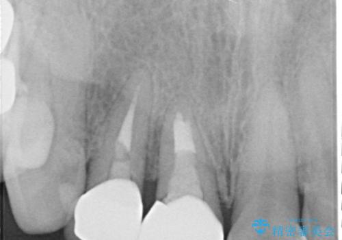 破折した前歯のインプラント 1DAYインプラントで短期間治療の治療前