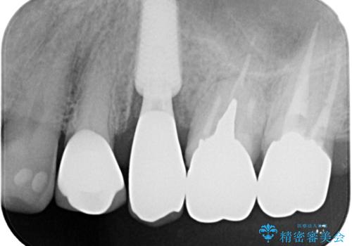破折した奥歯　抜歯即時埋入インプラントによる補綴治療の治療後
