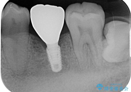 放置した欠損部 奥歯の即時荷重インプラント治療の治療後