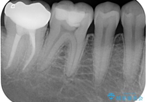 違和感が続く奥歯 慎重な診断を行ったむし歯治療の治療後