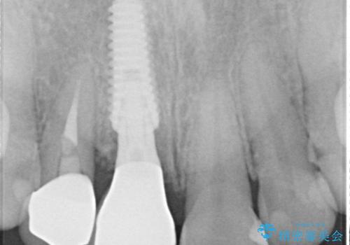 破折した前歯のインプラント 1DAYインプラントで短期間治療の治療後