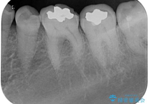 銀歯の周りがむし歯に ゴールドインレーによるむし歯治療の治療前