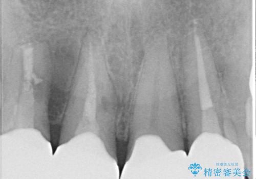前歯の審美歯科治療 下顎の部分矯正と上顎前歯のオールセラミッククラウンの治療後