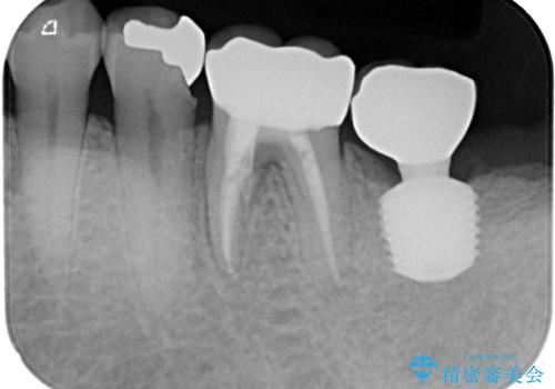 咬合力で破折した奥歯 抜歯即時インプラントで短期間治療の治療前