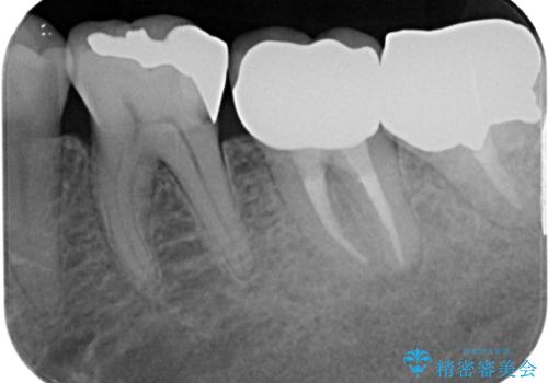痛すぎて食事がとれない 奥歯の根管治療の治療後