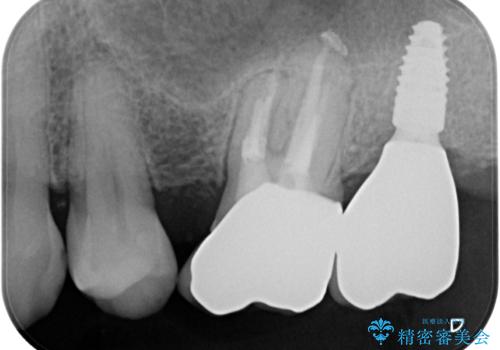 奥歯のむし歯が気になる 根管治療とインプラント治療の治療後