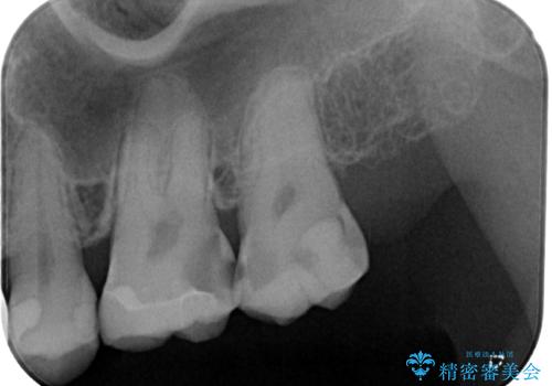 奥歯の大きなむし歯 神経を残してセラミック治療の治療前
