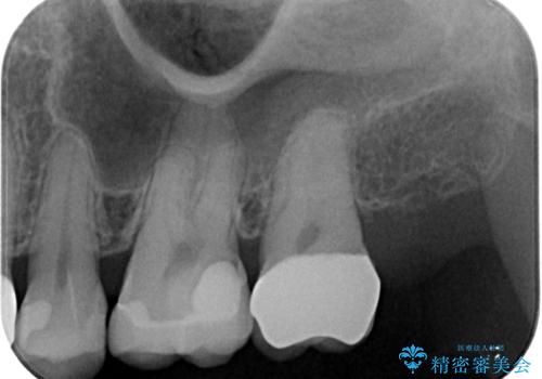 奥歯の大きなむし歯 神経を残してセラミック治療の治療後
