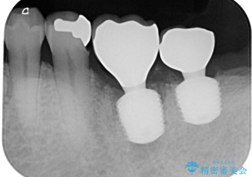 咬合力で破折した奥歯 抜歯即時インプラントで短期間治療の治療後