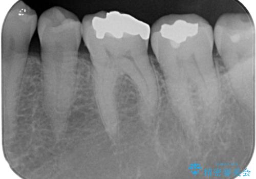 銀歯の周りがむし歯に ゴールドインレーによるむし歯治療の治療後