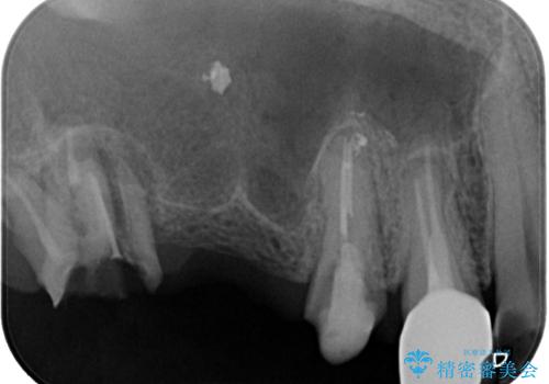 割れてしまった奥歯 抜歯即時埋入インプラントによる短期間治療の治療前