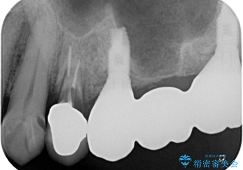 割れてしまった奥歯 抜歯即時埋入インプラントによる短期間治療の治療前