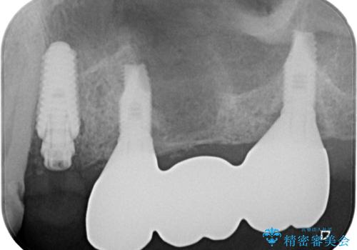割れてしまった奥歯 抜歯即時埋入インプラントによる短期間治療の治療中