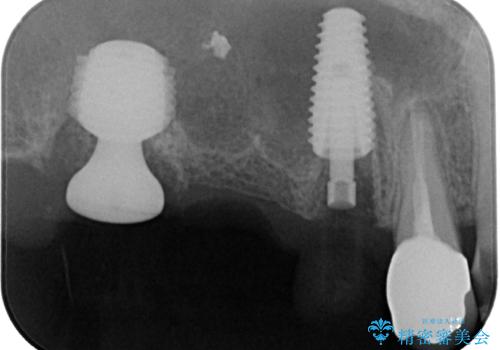 割れてしまった奥歯 抜歯即時埋入インプラントによる短期間治療の治療中