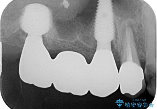 割れてしまった奥歯 抜歯即時埋入インプラントによる短期間治療の治療後