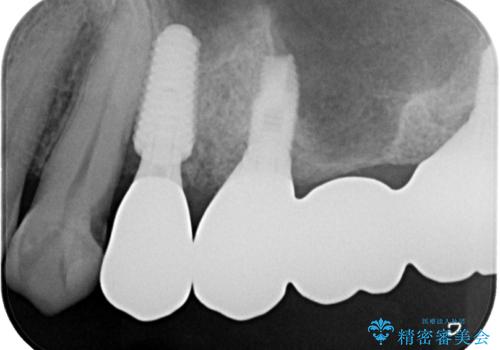 割れてしまった奥歯 抜歯即時埋入インプラントによる短期間治療の治療後