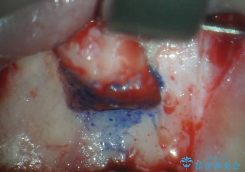 変色してきた歯とプラスチックのクラウン オールセラミッククラウン治療の治療後