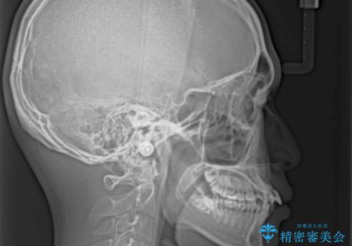 【モニター】出っ歯と奥歯の咬み合わせを改善　補助装置を用いたワイヤー抜歯矯正の治療前
