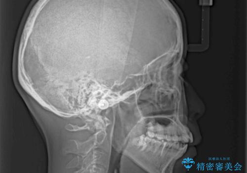 【モニター】飛び出した上顎前歯 補助装置を併用したインビザライン矯正治療の治療前