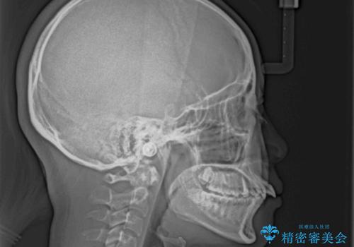 飛び出した口元を改善したい　ワイヤー装置による抜歯矯正治療の治療前