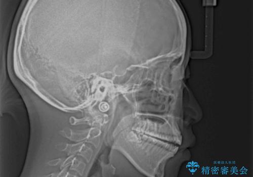 前歯のオープンバイト　インビザラインで咬み合わせを改善の治療前