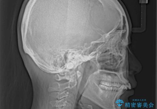 全顎的なデコボコと口元の突出感 ワイヤー装置での抜歯矯正で整った口元にの治療前