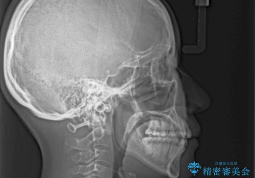 飛び出した前歯とデコボコ　ワイヤー装置での抜歯矯正の治療前
