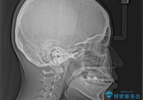 唇を閉じて眠れない　ワイヤー装置での抜歯矯正で口元をスッキリとの治療前