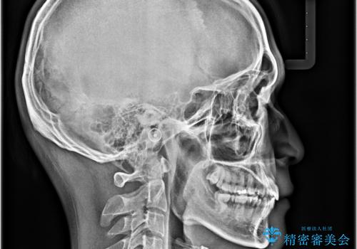 【モニター】出っ歯と奥歯の咬み合わせを改善 補助装置を用いたワイヤー抜歯矯正の治療後