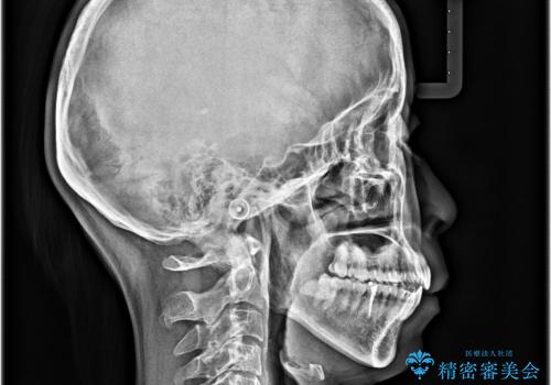 【モニター】飛び出した上顎前歯　補助装置を併用したインビザライン矯正治療の治療後