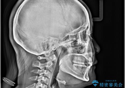 飛び出した口元を改善したい　ワイヤー装置による抜歯矯正治療の治療後