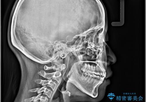 前歯のオープンバイト インビザラインで咬み合わせを改善の治療後