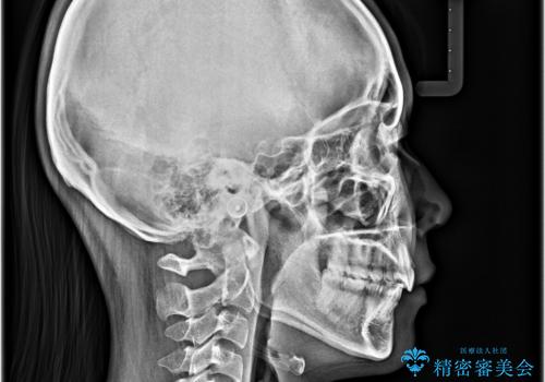 骨格的な出っ歯を抜歯矯正で改善 横顔の印象が劇的に変化の治療後