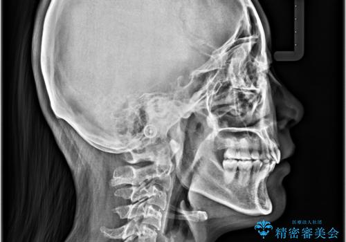 全顎的なデコボコと口元の突出感 ワイヤー装置での抜歯矯正で整った口元にの治療後
