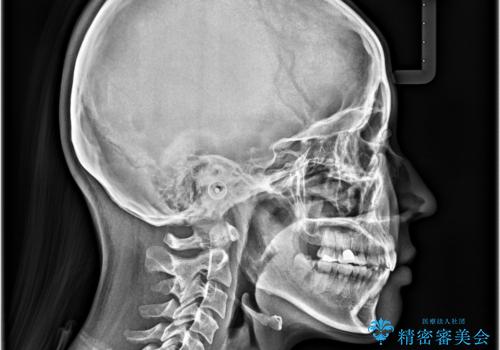 唇を閉じて眠れない ワイヤー装置での抜歯矯正で口元をスッキリとの治療後