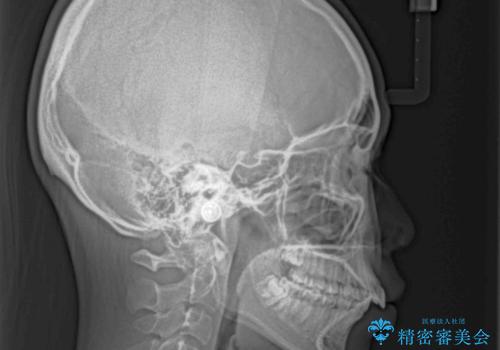 骨格的な出っ歯を抜歯矯正で改善　横顔の印象が劇的に変化の治療前