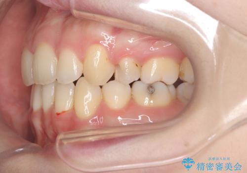 口ボコと歯のデコボコが気になる!|前歯が出ていて口が閉じにくい|審美ワイヤー矯正による口元の改善!の治療後
