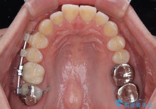 挺出歯を圧下してスペースを確保!目立たない部分矯正で下顎大臼歯にインプラント治療を実現の治療中