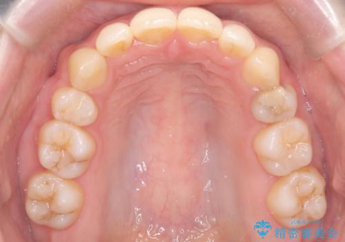 口ボコと歯のデコボコが気になる!|前歯が出ていて口が閉じにくい|審美ワイヤー矯正による口元の改善!の治療後