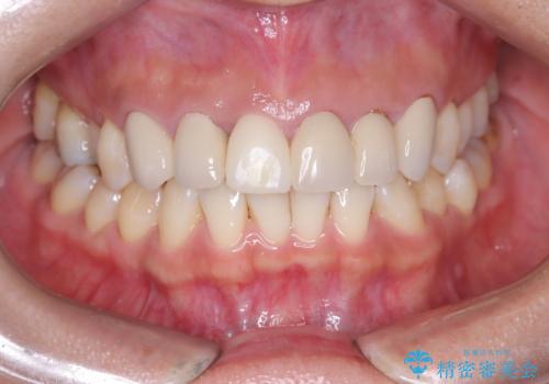 セラミック治療前のホワイトニングの治療前