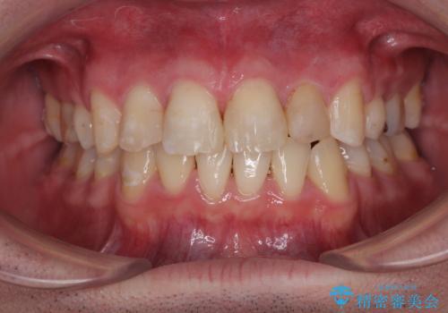 【モニター】出っ歯と奥歯の咬み合わせを改善 補助装置を用いたワイヤー抜歯矯正の症例 治療後