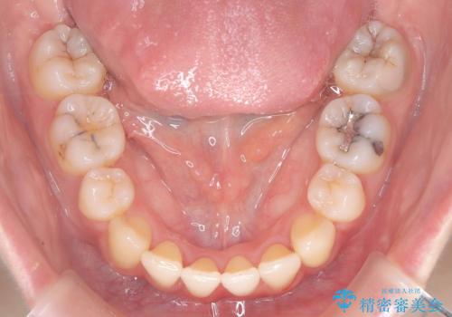 口ボコと歯のデコボコが気になる!|前歯が出ていて口が閉じにくい|審美ワイヤー矯正による口元の改善!の治療後