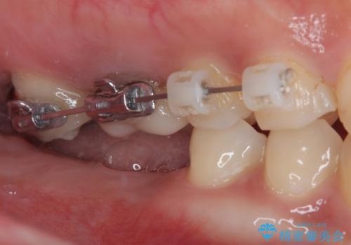 挺出歯を圧下してスペースを確保!目立たない部分矯正で下顎大臼歯にインプラント治療を実現の治療中