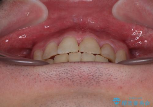 【モニター】出っ歯と奥歯の咬み合わせを改善 補助装置を用いたワイヤー抜歯矯正の治療後